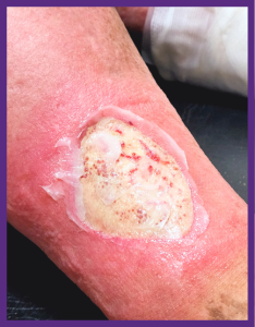 up close photo of a diabetic ulcer on a leg, with pus, surrounded by very red skin